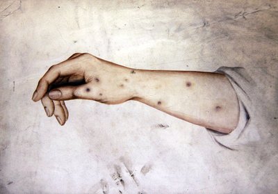 Studie av en underarm med hudtilstand, ca. 1850 (akvarell på papir) av William Lover