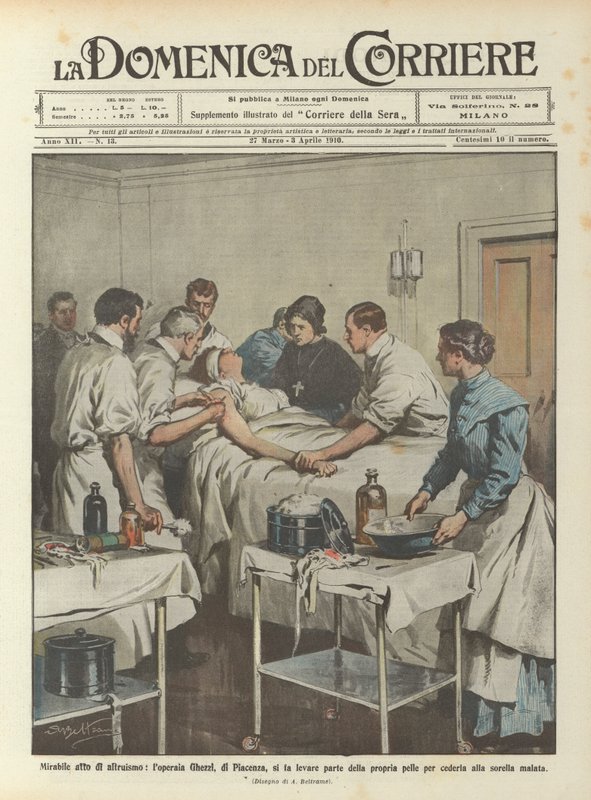 Beundringsverdig altruisme, arbeideren Ghezzi, fra Piacenza, har en del av huden hennes fjernet? av Achille Beltrame