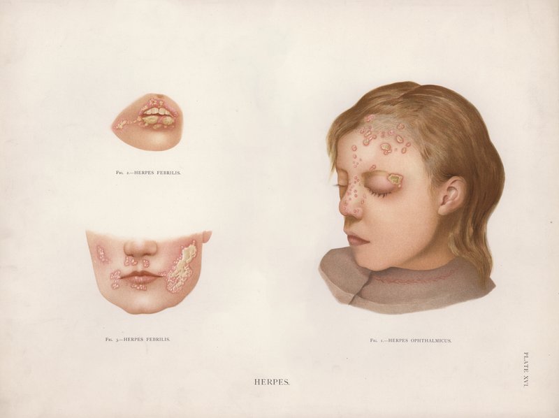 Hudsykdommer: Herpes (farge litho) av English School