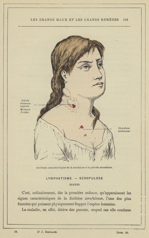 Karakteristiske ulykker av skrofulose i sekundærperioden (farge litho) av French School