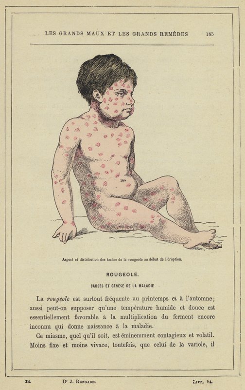 Utseende og fordeling av meslinger ved begynnelsen av utbruddet (farge litho) av French School