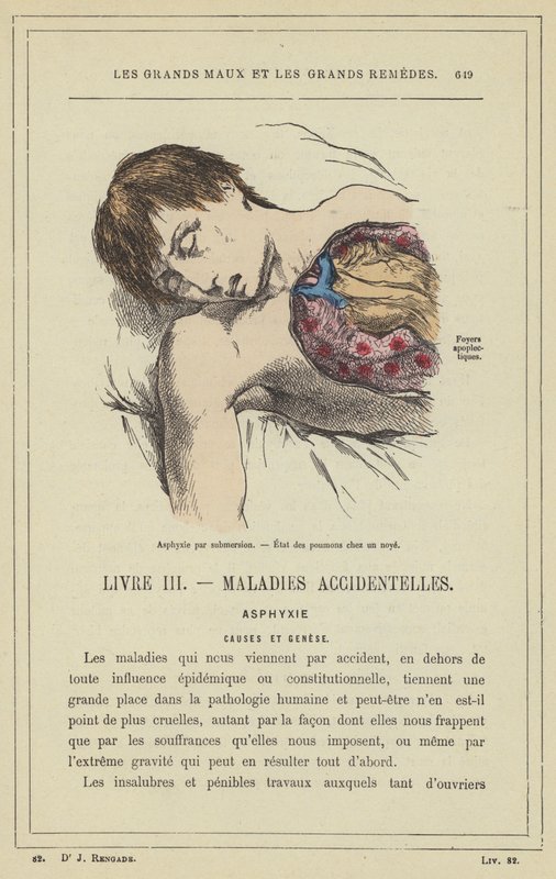 Asfyksi ved nedsenkning, tilstanden til lungene ved drukning (farge litho) av French School