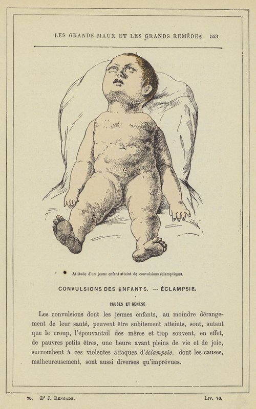Holdning til et lite barn med eklamptiske kramper (farge litho) av French School