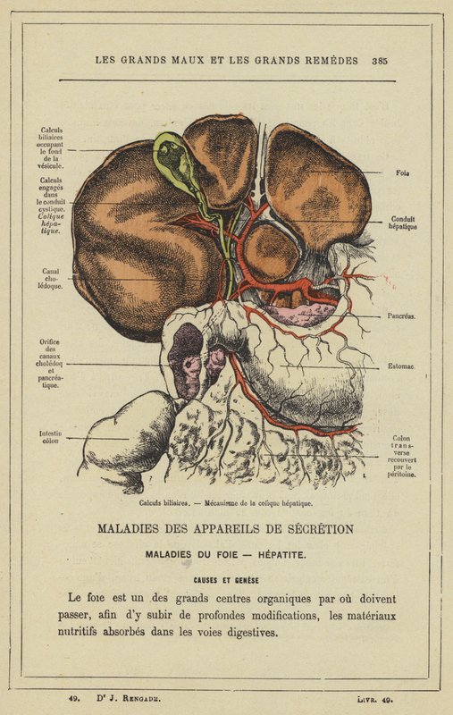 Gallestein, mekanisme for hepatisk kolikk (farge litho) av French School