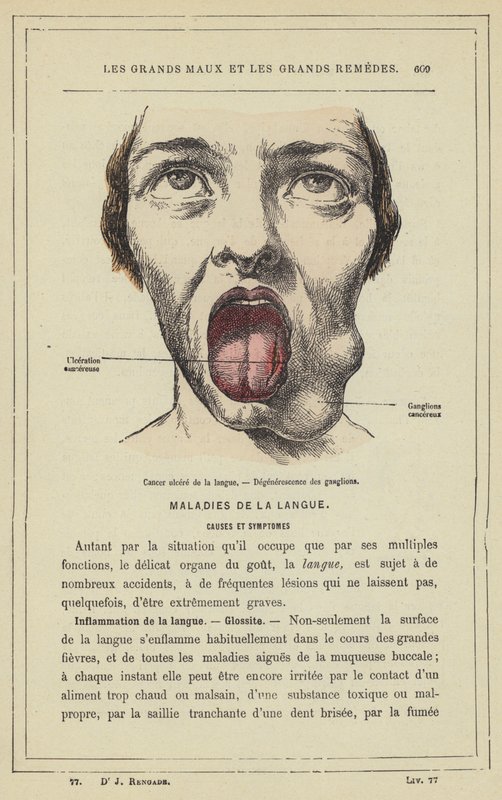 Tungesårkreft, lymfeknutedegenerasjon (farge litho) av French School