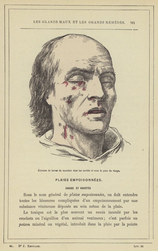 Klekking av fluelarver i hulrommene og under huden i ansiktet (farge litho) av French School