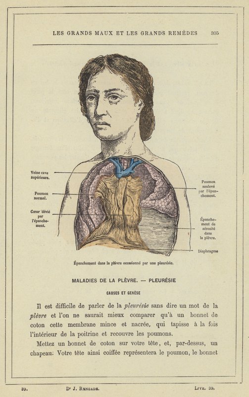 Effusjon i pleura forårsaket av pleuritt (fargelitho) av French School
