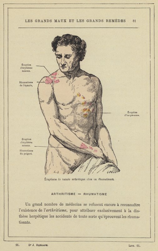 Utbrudd av leddgikt hos en revmatisk pasient (farge litho) av French School