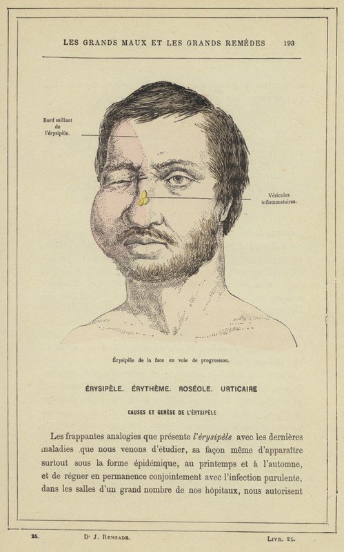 Progressiv ansikts erysipelas (farge litho) av French School
