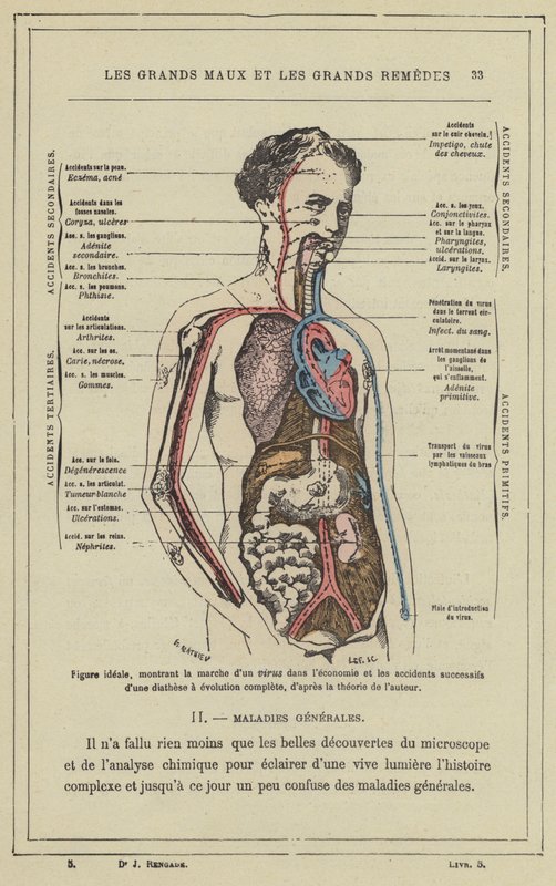 Ideell figur, som viser fremgangen til et virus i økonomien og de påfølgende ulykkene til en diatese med fullstendig evolusjon, i henhold til forfatterens teori (farge litho) av French School