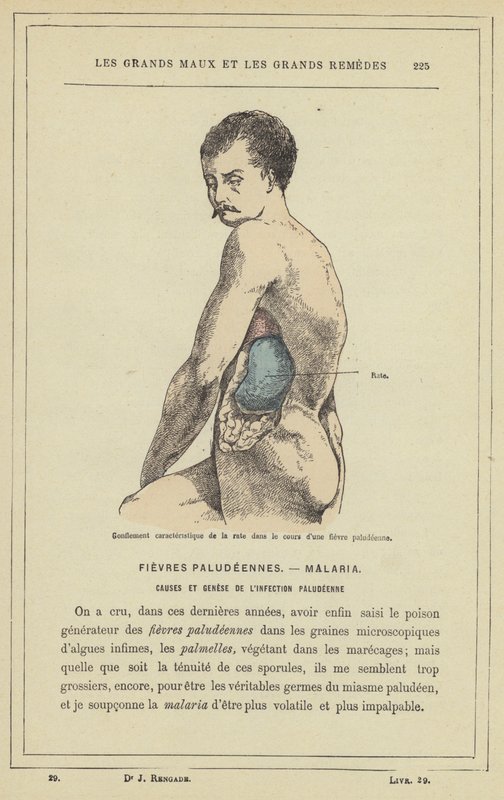 Karakteristisk hevelse i milten i løpet av malariafeber (farge litho) av French School
