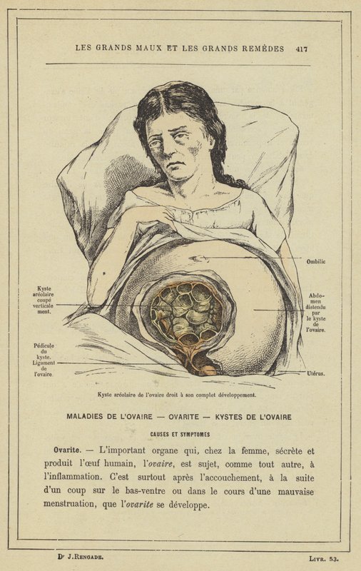 Areolar cyste i høyre eggstokk i full utvikling (farge litho) av French School