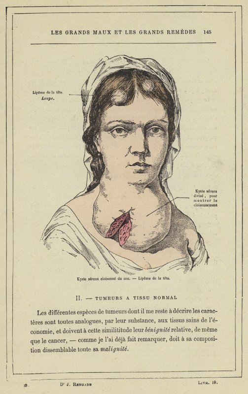 Cloisonne serøs cyste i nakken, Lipoma i hodet (farge litho) av French School