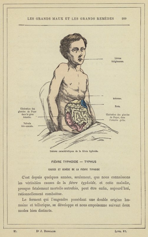 Karakteristiske lesjoner av tyfoidfeber (farge litho) av French School