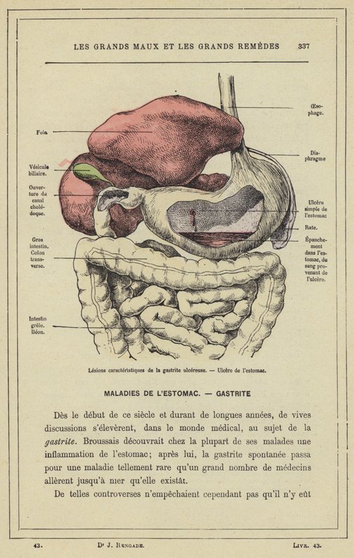 Karakteristiske lesjoner av ulcerøs gastritt, magesår (farge litho) av French School