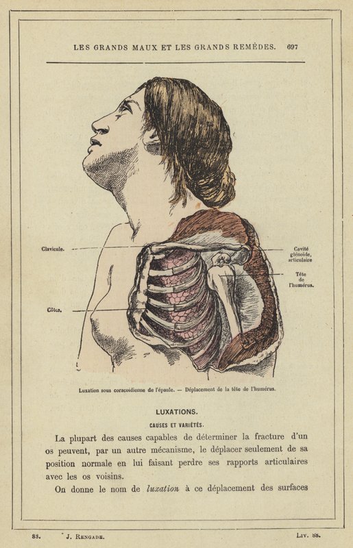 Subcoracoid dislokasjon av skulderen, forskyvning av hodet på humerus (farge litho) av French School