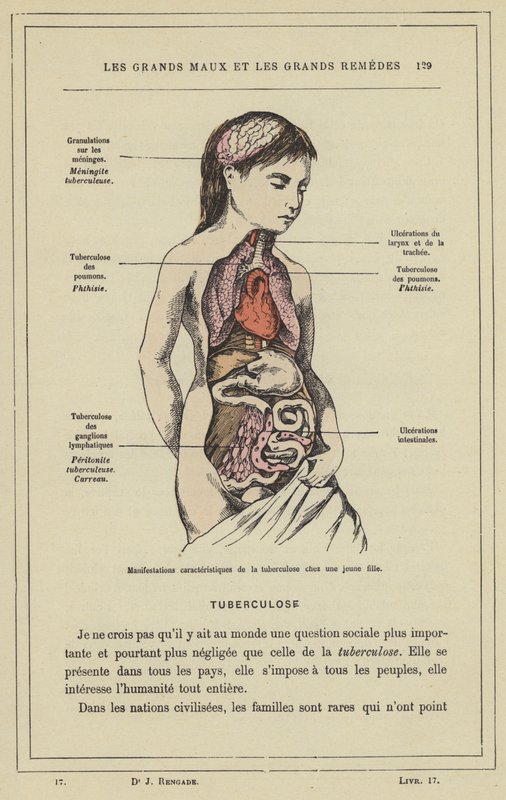 Karakteristiske manifestasjoner av tuberkulose hos en ung jente (farge litho) av French School