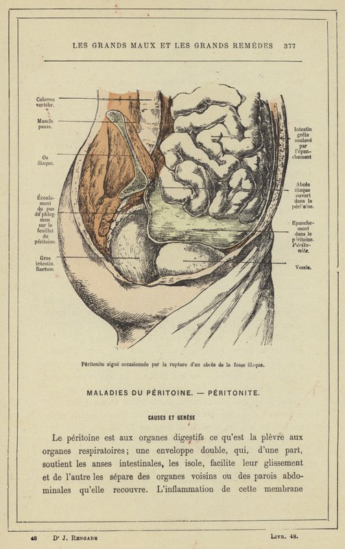 Akutt peritonitt forårsaket av ruptur av iliac fossa abscess (farge litho) av French School