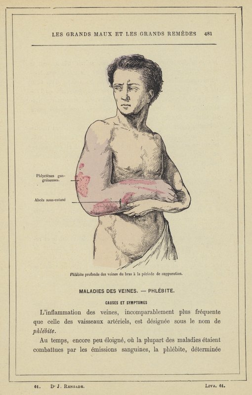 Dyp flebitt i armens årer ved suppurasjonsperioden (farge litho) av French School