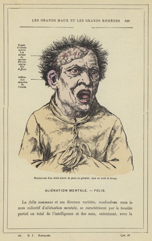 Fysiognomi av en romvesen rammet av paral sie generale, i et rasende anfall (farge litho) av French School