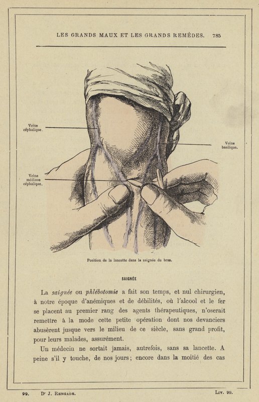 Posisjon av lansetten i armblødningen (farge litho) av French School