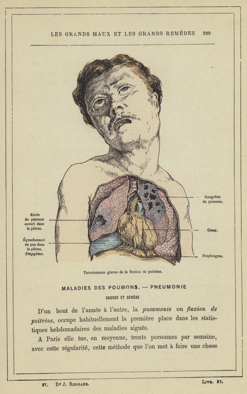 Alvorlige avslutninger av brystfluksjon (farge litho) av French School
