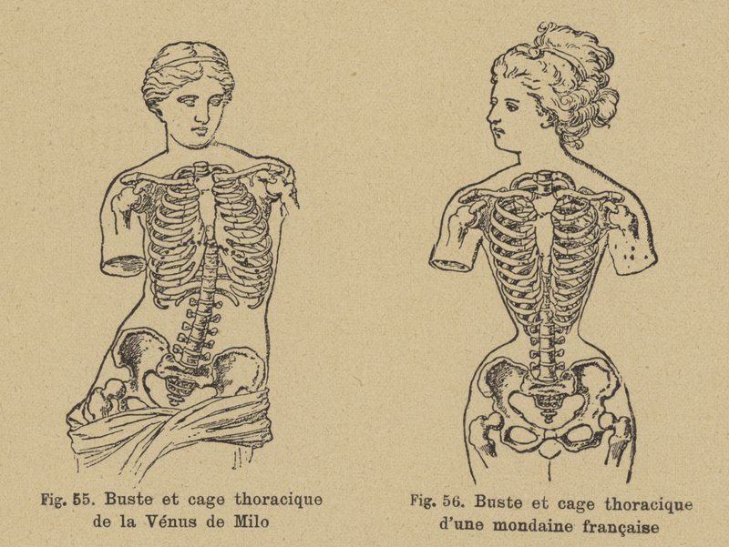 Sammenligning av formen på brystet og brystkassen til Venus de Milo med formen til en fransk sosialist fra slutten av 1800-tallet av German School