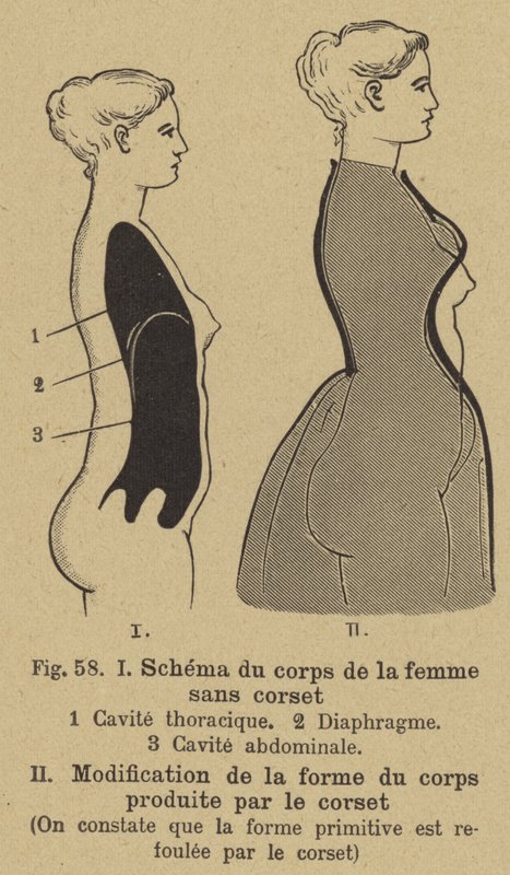 Diagram som viser effekten av å bruke korsett på formen til en kvinnes kropp av German School