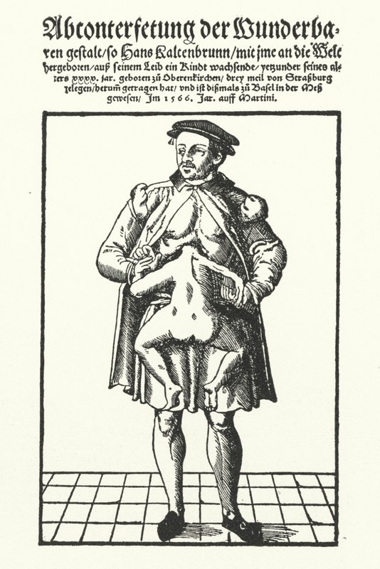 Hans Kaltenbrunn og hans uutviklede sammenflettede tvilling (gravering) av German School