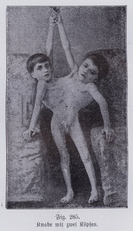 Giacomo og Giovanni Battista Tocci, italienske sammenflettede tvillinger (s/h-bilde) av Italian Photographer