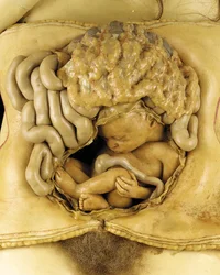 Anatomisk modell av en eggstokkgraviditet, detalj (voks) (se også 1126545-7)