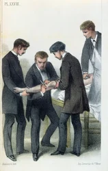 Amputere en arm, fra en medisinsk manual av Jean-Baptiste-Leon Dubreuil, ca. 1850-60