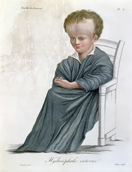 Intern Hydrocephalus, fra Nosologie Naturelle av Baron Jean Louis Alibert (1768-1837) gravert av Tresca, 1817