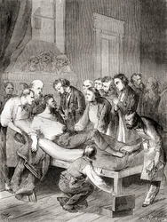 Den første offentlige demonstrasjonen av bruken av inhalert eter som et kirurgisk bedøvelsesmiddel i 1846 av en amerikansk tannlege, William Thomas Green Morton, fra 'Les Merveilles de la Science', publisert ca. 1870