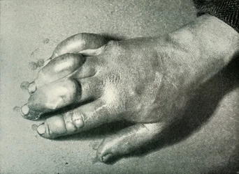 Dr. Atkinsons Frost-Bitten Hand, 5. juli 1911, 1913
