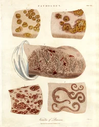 Patologiske hudforandringer: Varianter av psoriasis