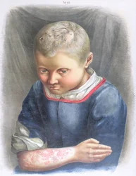 Favus, fra en bok av Daniel Cornelius Danielssen (1815-94) 1892