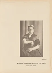 Cerebral atrofi: Partiell epilepsi Høyre hemiplegi