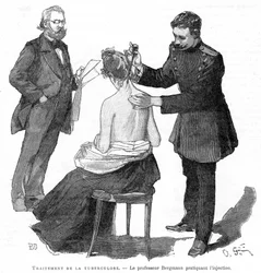 Professor Bergmann injiserer en tuberkulosepasient, 1891