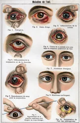 Diseases of the Eye. “The new natural medicine” by F.E. Bilz.