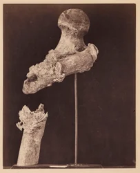 Løytnant Goodwin, avdød, uforent skuddbrudd i den øvre tredjedelen av høyre femur, syv måneder etter skaden, fra den fotografiske katalogen til den kirurgiske seksjonen.