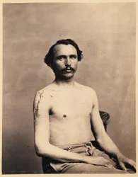 Menig Adolph Zirsse, vellykket mellomliggende eksisjon av hodet og to og en halv tomme av skaftet til høyre humerus, fra den fotografiske katalogen til den kirurgiske seksjonen.