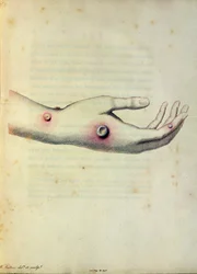 Cowpox pustle på armen til Sarah Nelmes, fra 